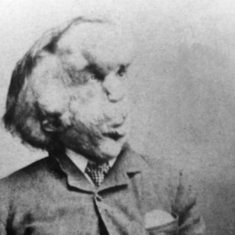 Joseph Merrick